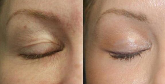 Take care of areas near the eyes