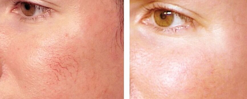 Eliminate the Red Disease