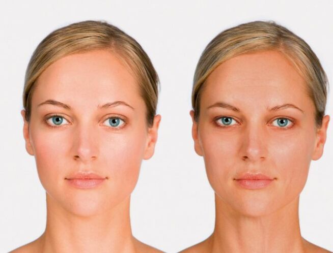 Facing and before rejuvenation