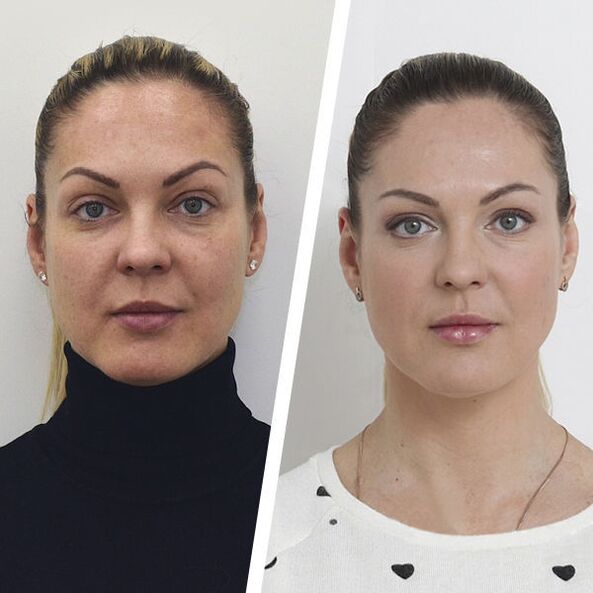Before and after facial rejuvenation without surgery
