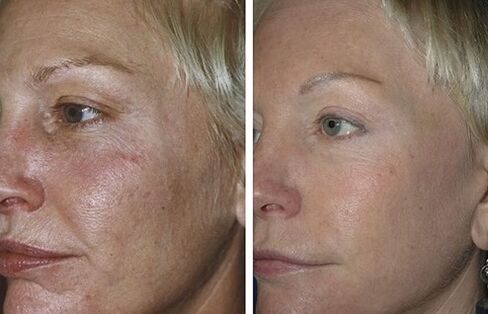 Before and after images of skin rejuvenation with Fractional Laser