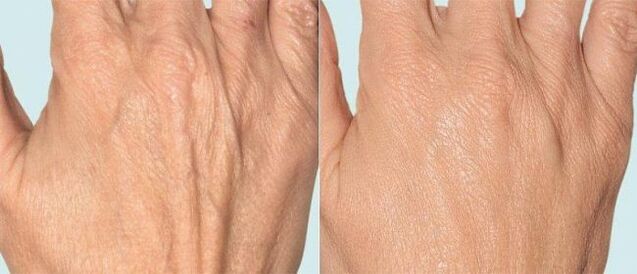 Hand skin before and after microneedling treatment
