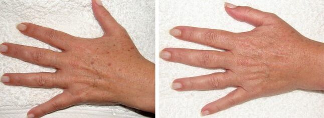 The result is the removal of melasma on the hands